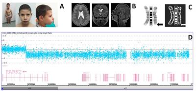 Developmental Coordination Disorder in a Patient with <mark class="highlighted">Mental Disability</mark> and a Mild Phenotype Carrying Terminal 6q26-qter Deletion